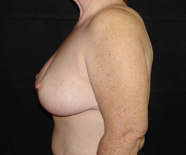 after breast reduction left view female patient case 3941