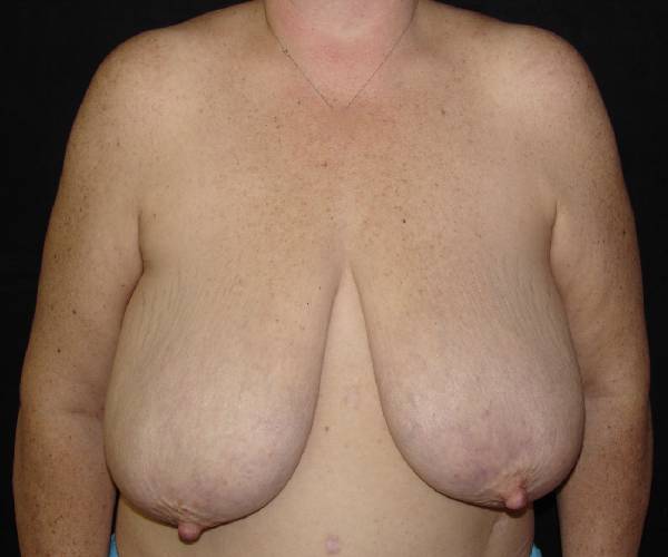 before breast reduction front view female patient case 3941