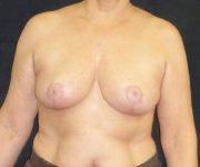 after breast reduction front view female patient case 3972