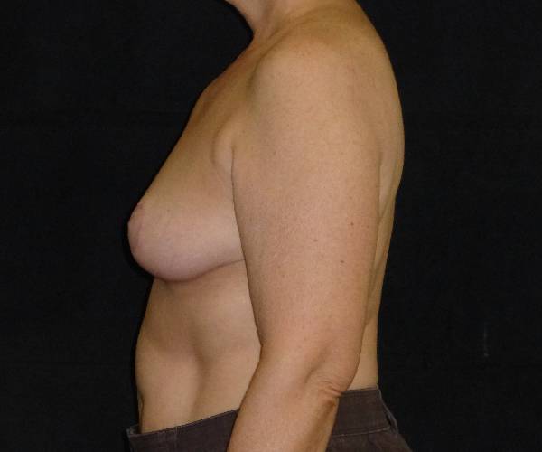 after breast reduction left view female patient case 3972