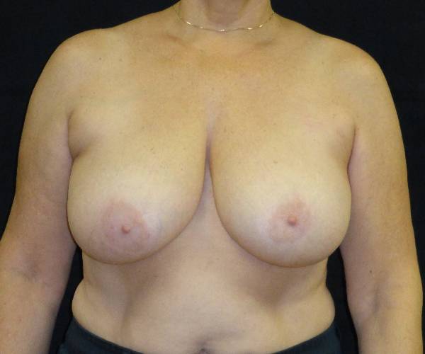 before breast reduction front view female patient case 3972
