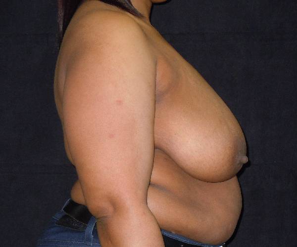 before breast reduction right view female patient case 3977