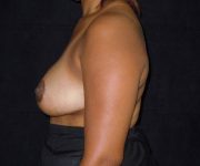 after breast reduction left view female patient case 3996