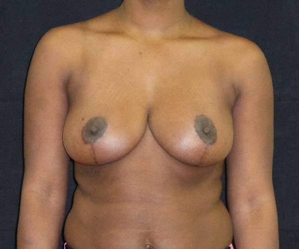 after breast reduction front view female patient case 4006