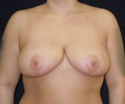 after breast reduction front view female patient case 4011