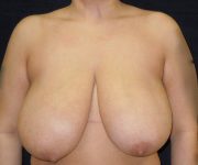 before breast reduction front view female patient case 4011