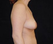 after breast reduction right view female patient case 4016