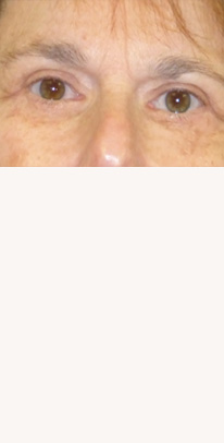 before eyelid surgery female patient case 3381