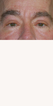 after eyelid surgery male patient case 3384