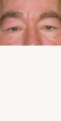 before eyelid surgery male patient case 3384