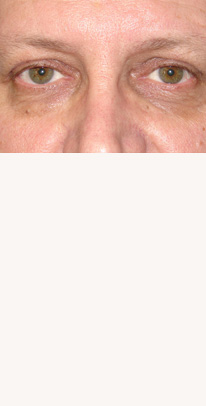 after eyelid surgery male patient case 3387