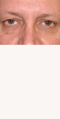 before eyelid surgery male patient case 3387