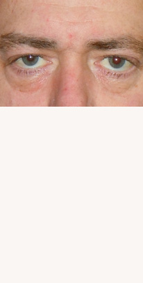 after eyelid surgery male patient case 3390