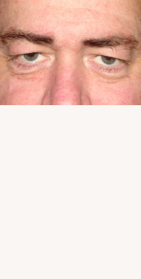 before eyelid surgery male patient case 3390