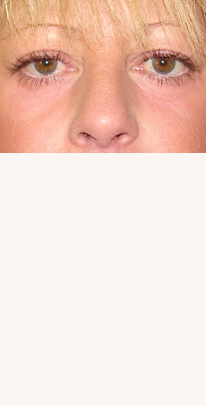 after eyelid surgery female patient case 3393