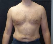 after Gynecomastia front view case 3475