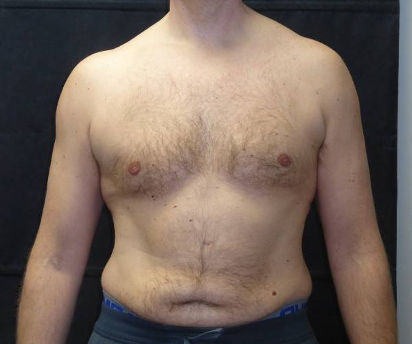 after Gynecomastia front view case 3475