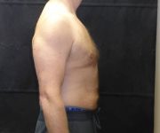 after Gynecomastia side view case 3475