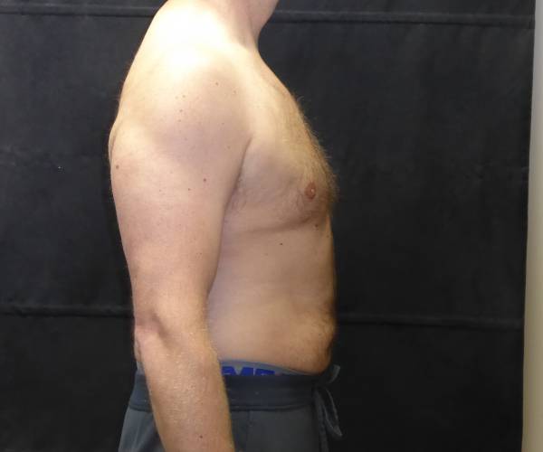 after Gynecomastia side view case 3475
