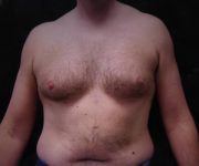 before Gynecomastia front view case 3475