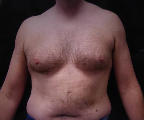 before Gynecomastia front view case 3475