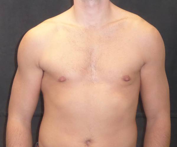 after Gynecomastia front view case 3480