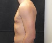 after Gynecomastia side view case 3480