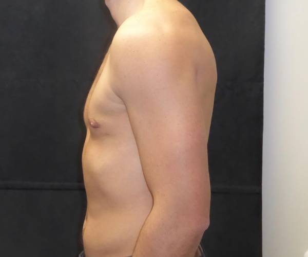 after Gynecomastia side view case 3480