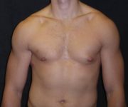 before Gynecomastia front view case 3480