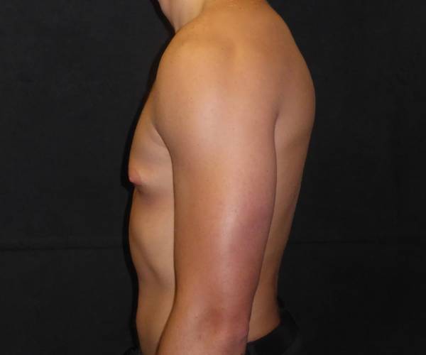 before Gynecomastia side view case 3480