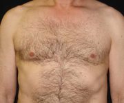 after Gynecomastia front view case 3485