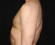 after Gynecomastia side view case 3485