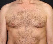 before Gynecomastia front view case 3485