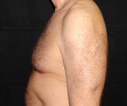 before Gynecomastia side view case 3485