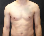 after Gynecomastia front view case 3491
