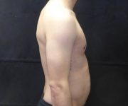 after Gynecomastia side view case 3491