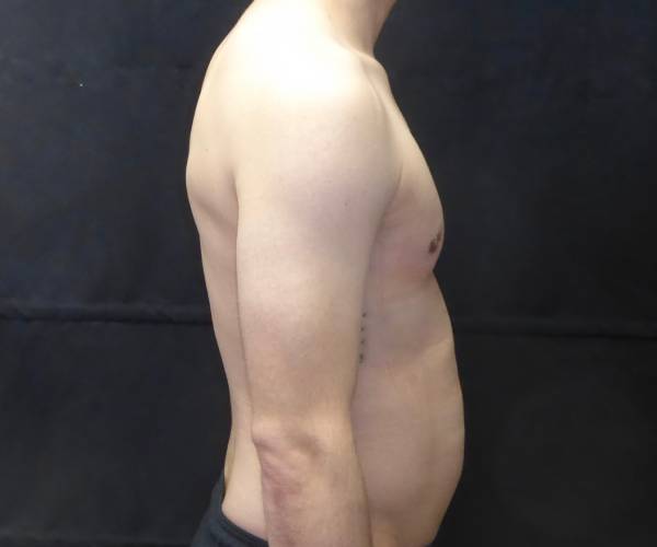 after Gynecomastia side view case 3491
