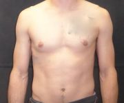 before Gynecomastia front view case 3491