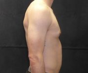 before Gynecomastia side view case 3491