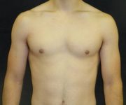 after Gynecomastia case 3496 front view