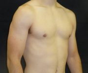 after Gynecomastia case 3496 angle view