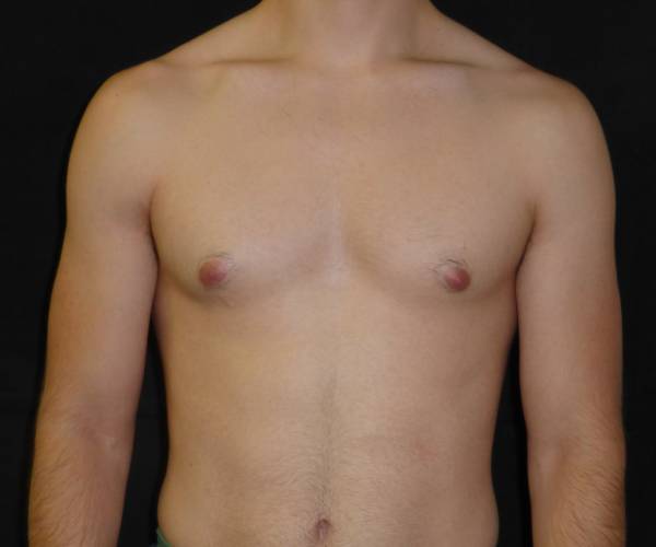 before Gynecomastia case 3496 front view