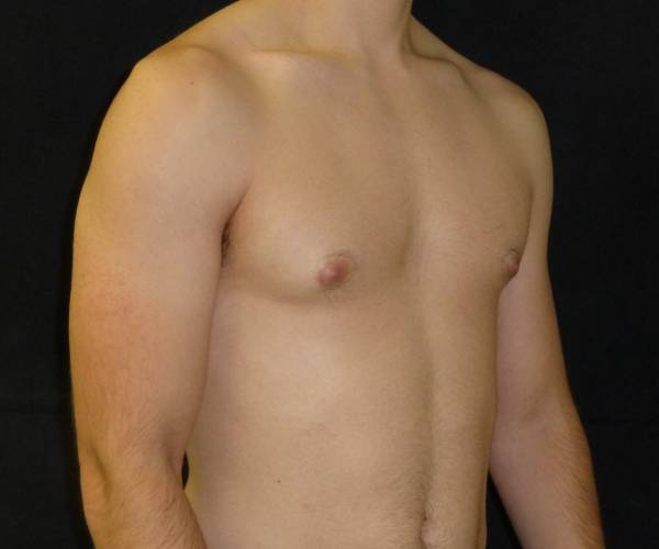 before Gynecomastia case 3496 angle view