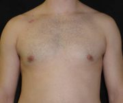 after Gynecomastia case 3501 front view