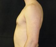 after Gynecomastia case 3501 side view