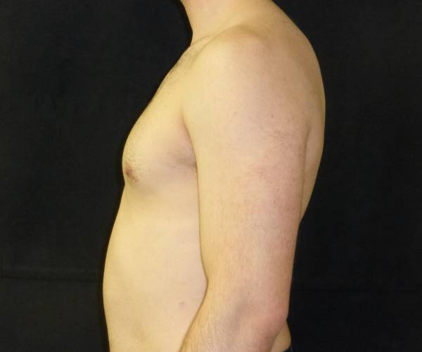after Gynecomastia case 3501 side view