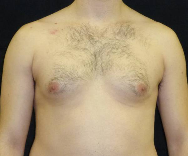 before Gynecomastia case 3501 front view