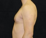 before Gynecomastia case 3501 side view