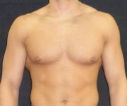 after Gynecomastia case 3506 front view