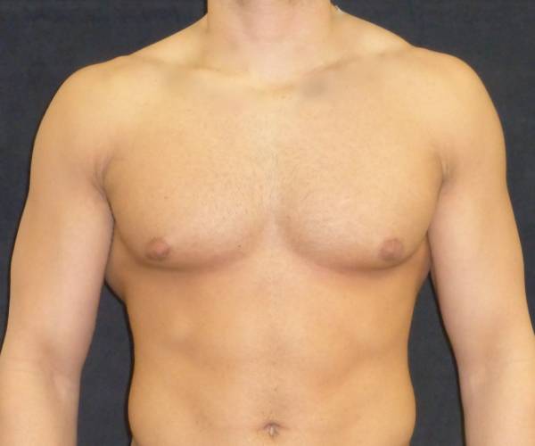after Gynecomastia case 3506 front view